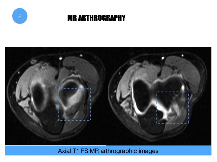 Figure 2 for case Elbow synovial fold syndrome (posterolateral impingement)